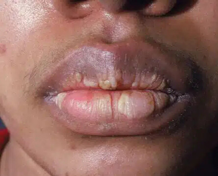 can too much vitamin c cause chapped lips Which Deficiency What nutrients are you lacking  Cracked Lips? Your Body is