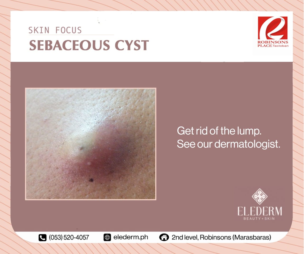 Elederm - Sebaceous cysts are small lumps that can form... | Facebook