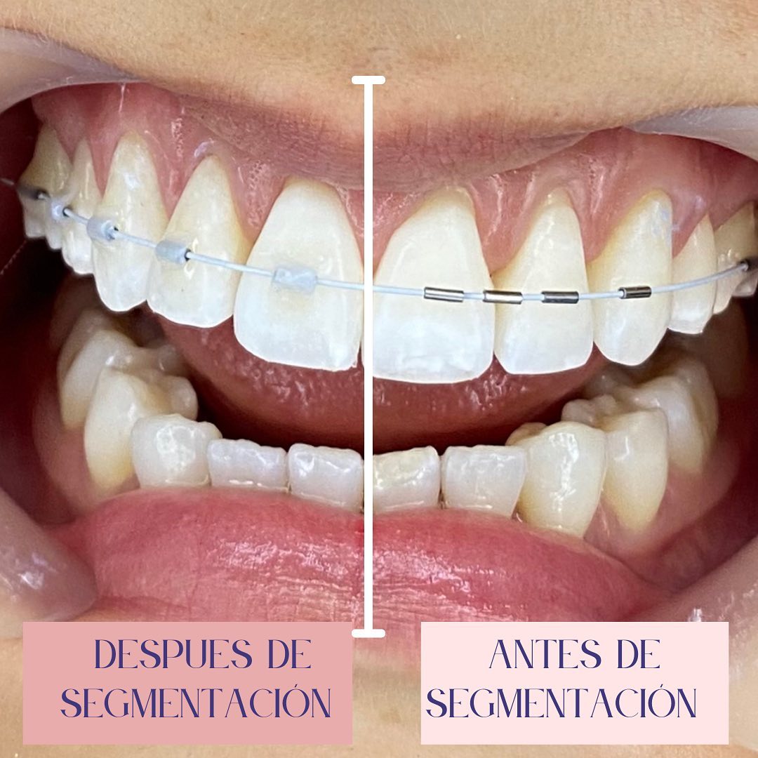 Clínica - FLOW JAC es un sistema de ortodoncia en donde los brackets ...