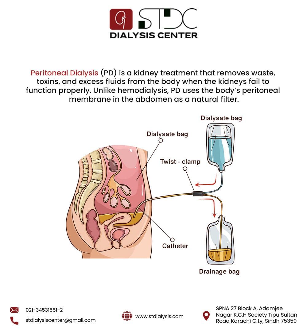 Abdul - Understanding Peritoneal Dialysis (PD). This treatment uses ...