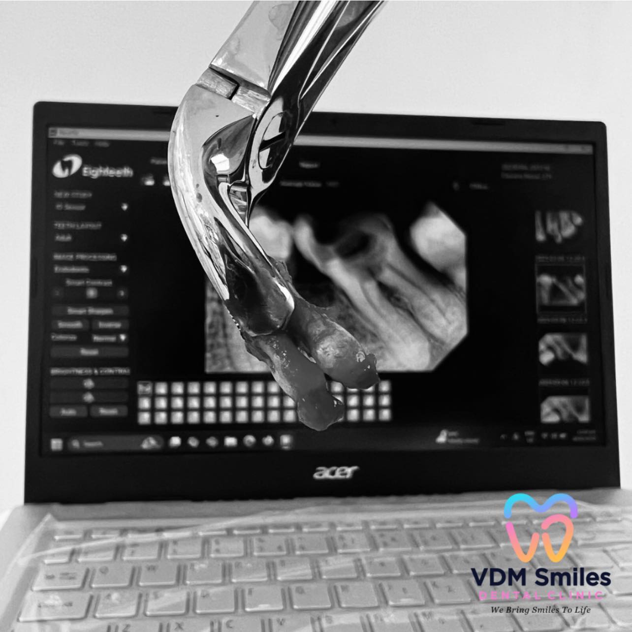 VDM - This tooth had to be removed due to severe decay, a reminder of ...