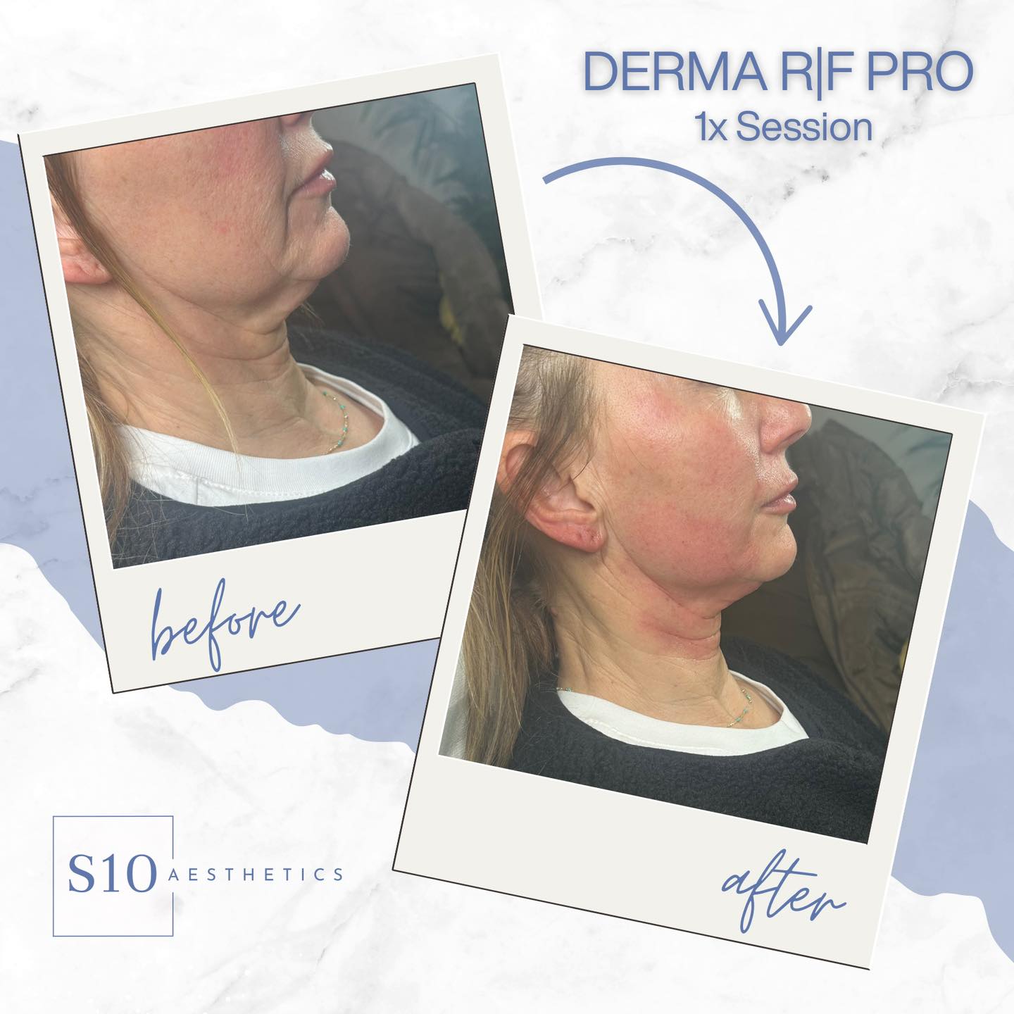 S10 Aesthetics - The Derma R|F PRO is engineered with... | Facebook