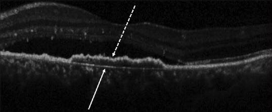 ”Double-layer sign” on... - Ophthalmology-Notes And Synopses