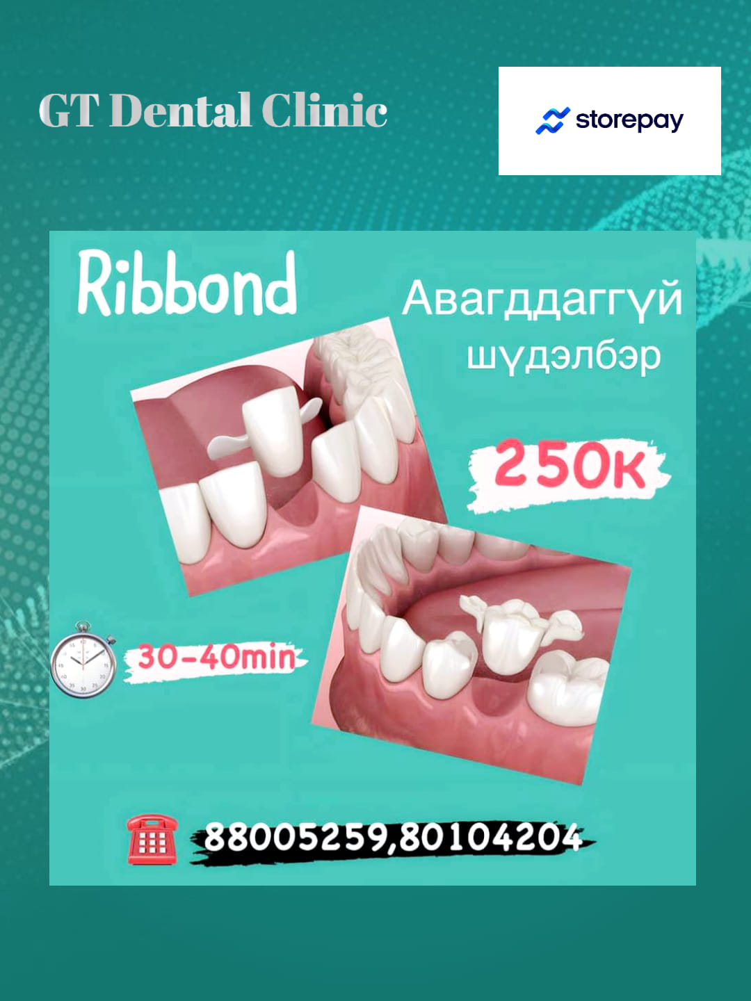 RIBBOND /РИББОНД/ АВАГДДАГГҮЙ ШҮД гэж... - GT Dental Clinic | Facebook