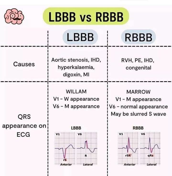 House - #ECG LBBB Vs RBBB on ECG!💪💪💪 Follow us on IG: http://www ...