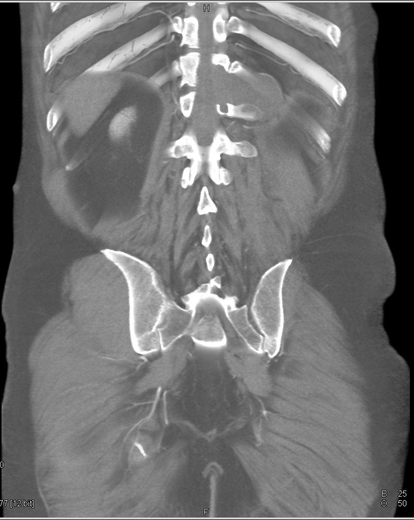 melanotic nerve sheath sarcoma symptoms Malignant Peripheral Tumor (MPNST) 083000160301 13 Liposomal Glutathione Benefits Count:Dihexa (#30 ct)