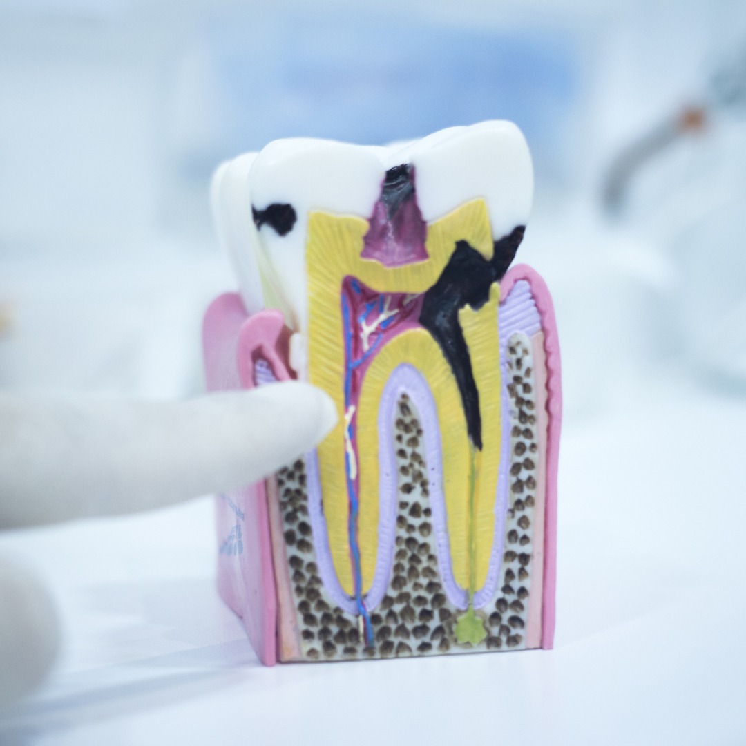 Field - Black or brown spots on your teeth? They could be signs of ...