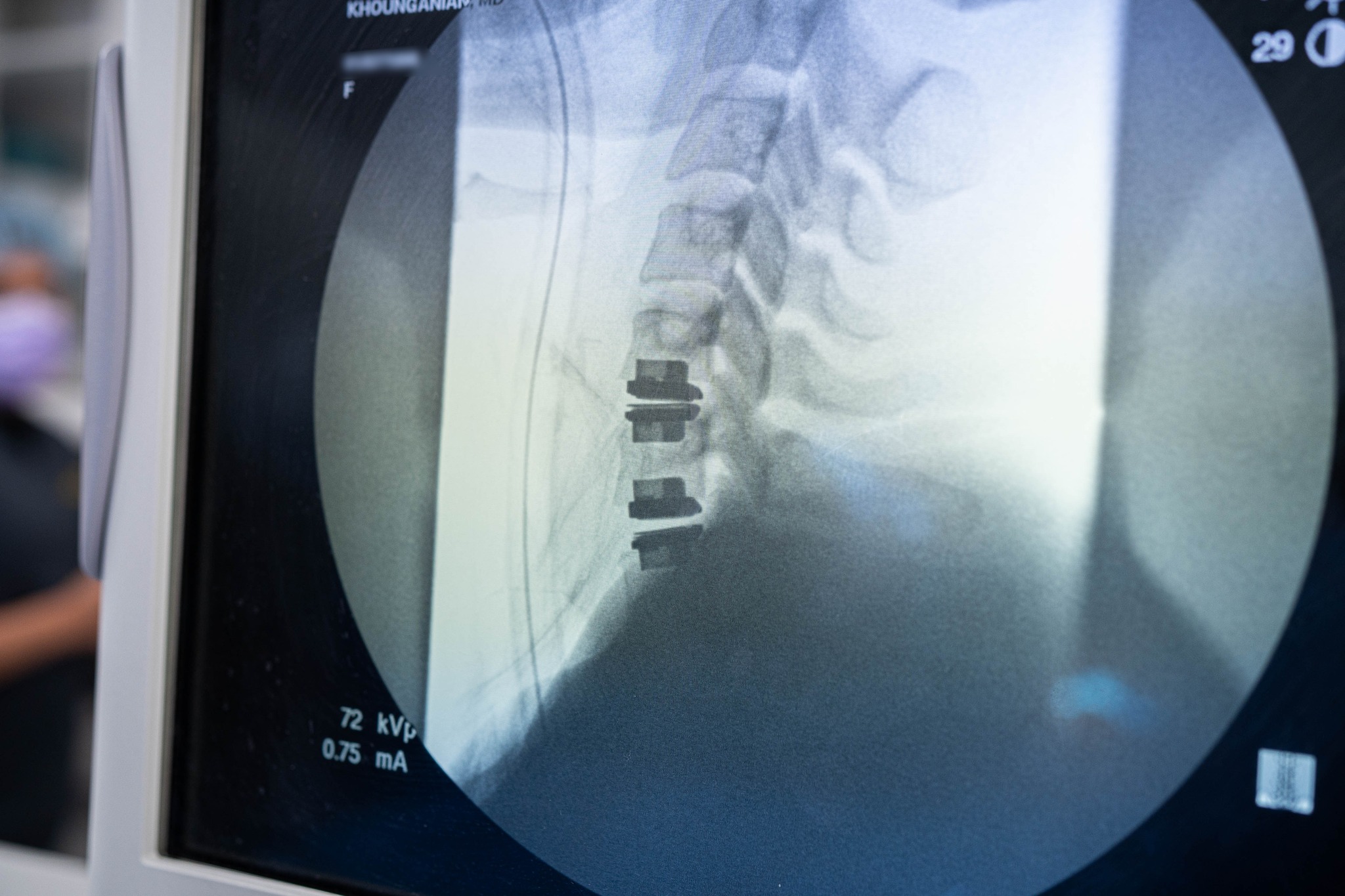 Two level artificial disc... - Greg S. Khounganian, MD