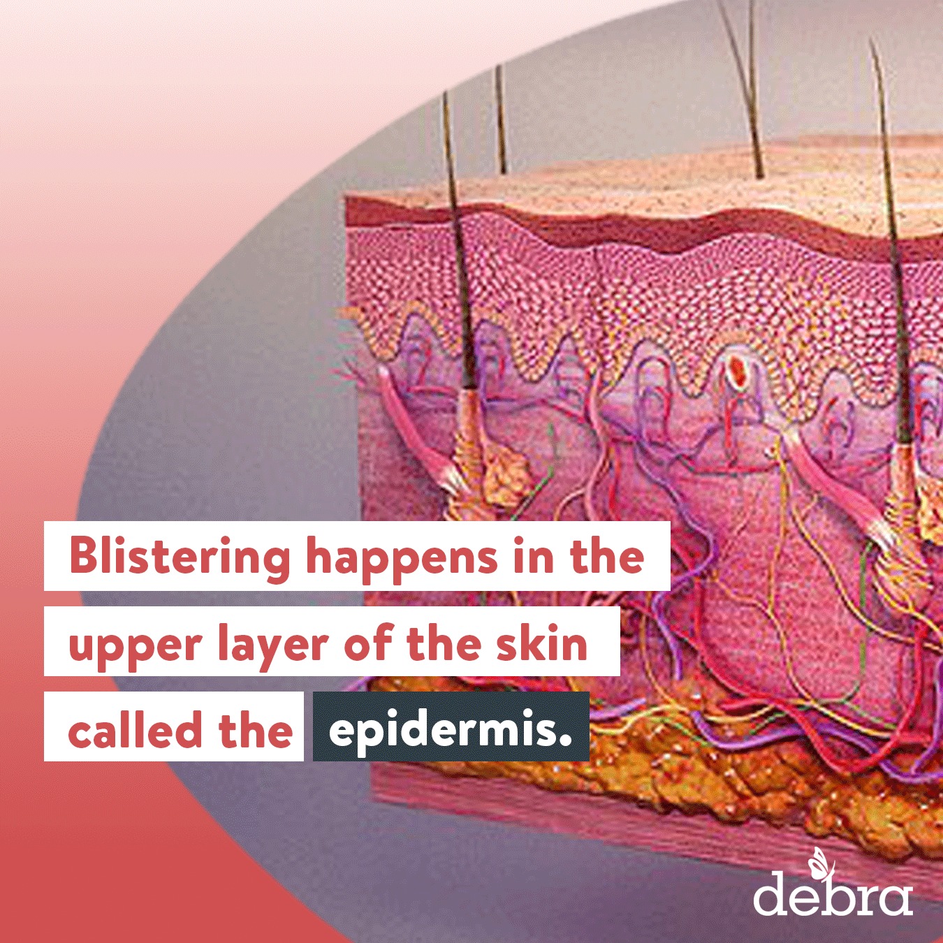 Epidermolysis Bullosa is a rare,... - debra of America