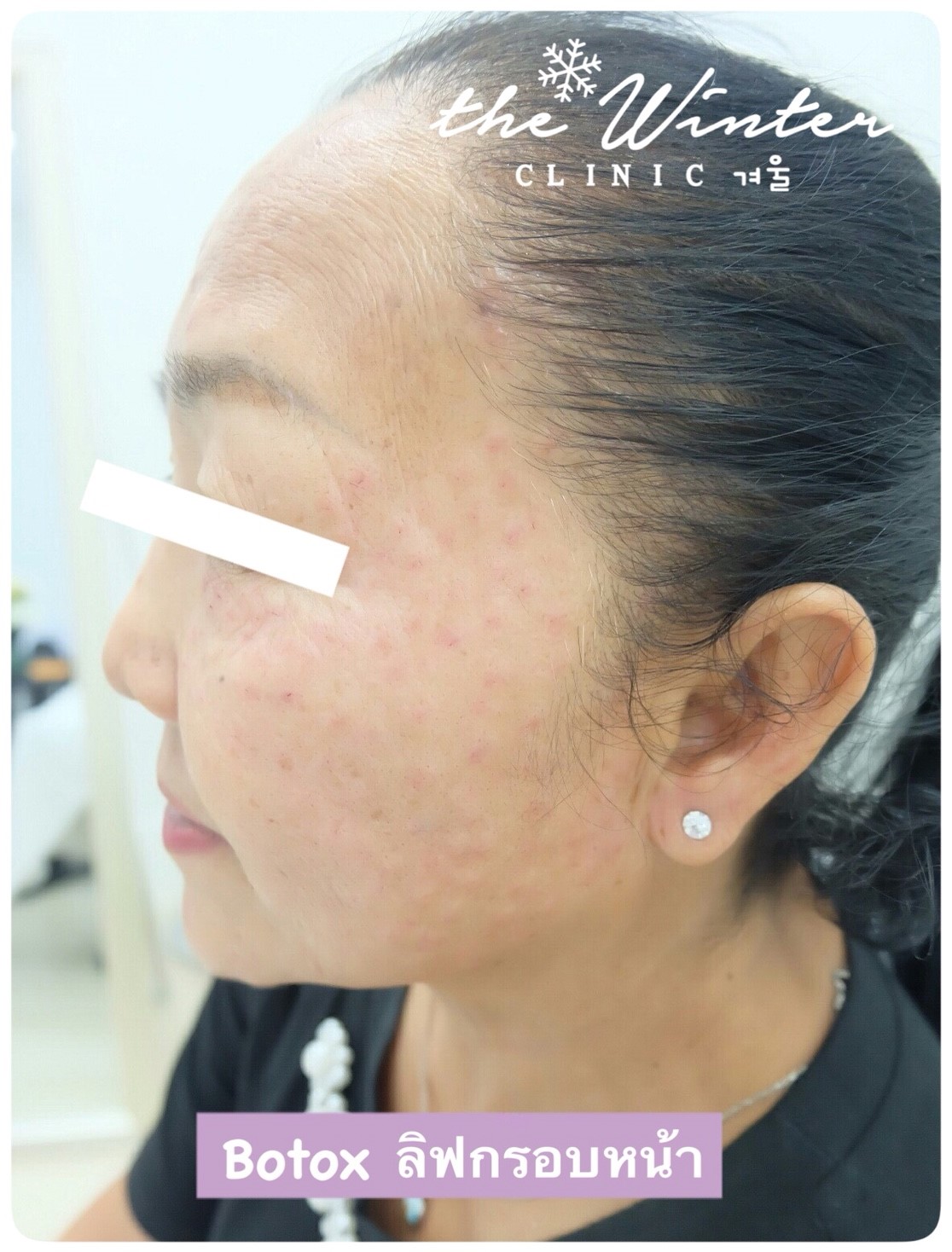 🍑 Botox Botulax 🍑... - The winter clinic