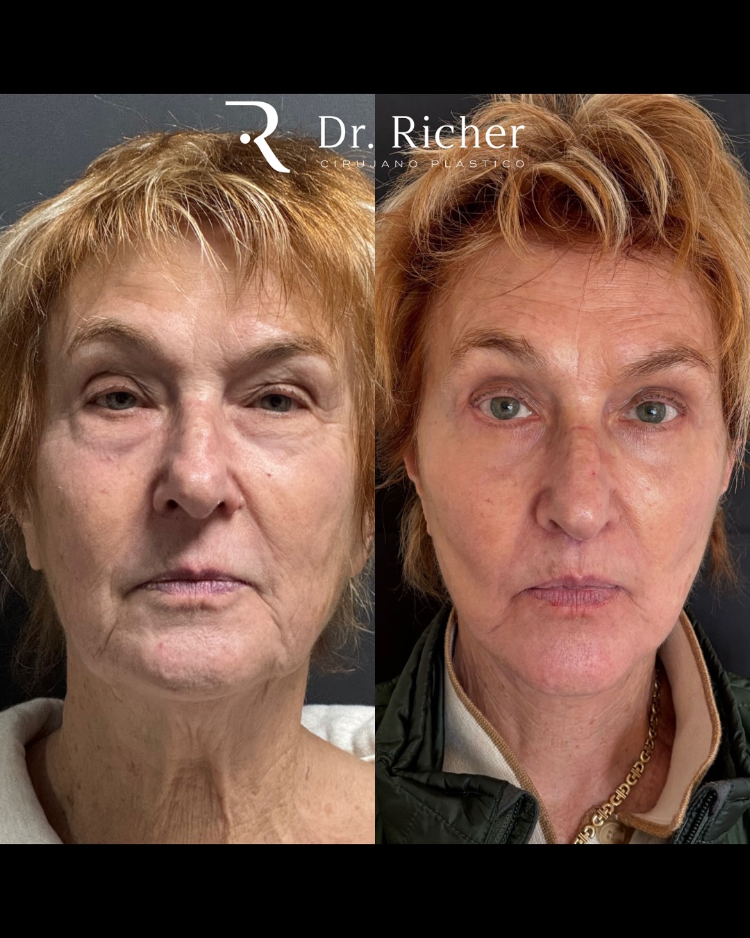 Dr. Richer Cirujano Plástico | San Pedro Garza Garcia