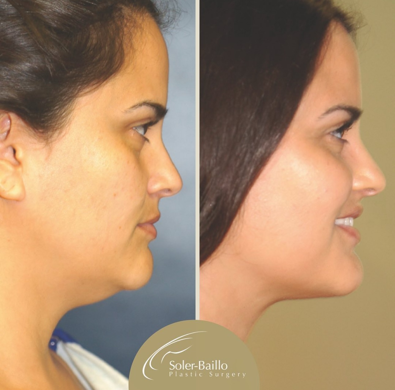 Soler Baillo Plastic... - Soler Baillo Plastic Surgery
