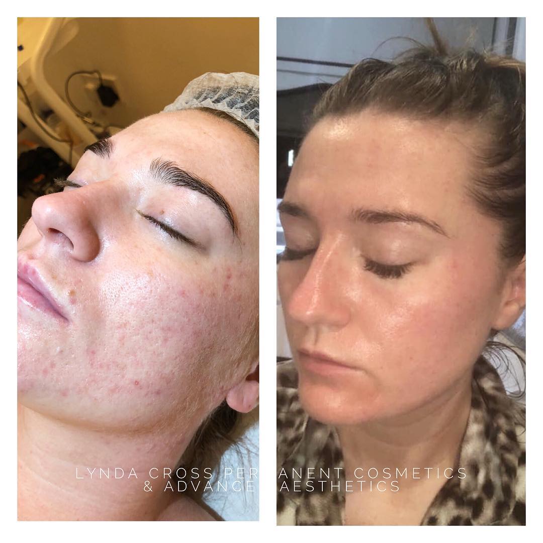 Lynda Cross Aesthetics - 🧬Dermapen medical skin needling targeting acne ...