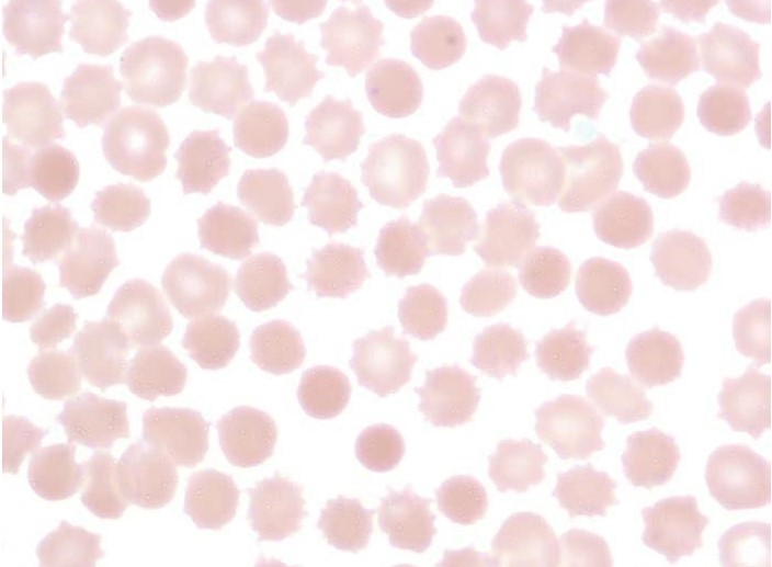 If the majority of the RBCs on the... - Hematology Society HS