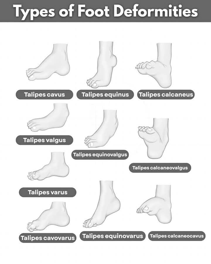 Doctor - Types of Foot Deformities (Talipes) ️ Talipes cavus → High ...