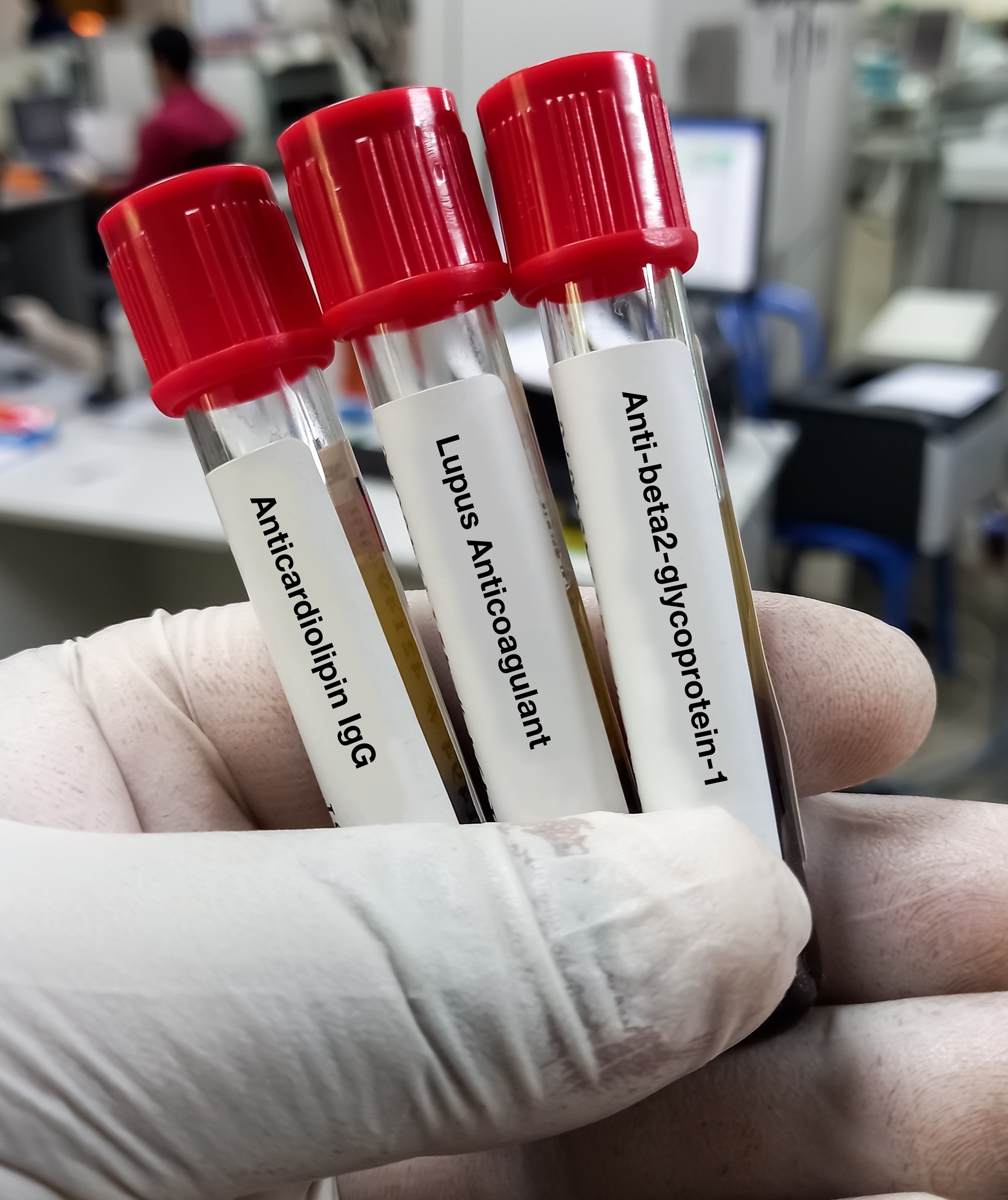 🩺 Living with APS? #Anticoagulants can complicate diagnosis! 🩹 # ...