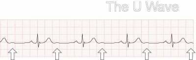 MedicTests.com - The U wave is a small wave that occurs...