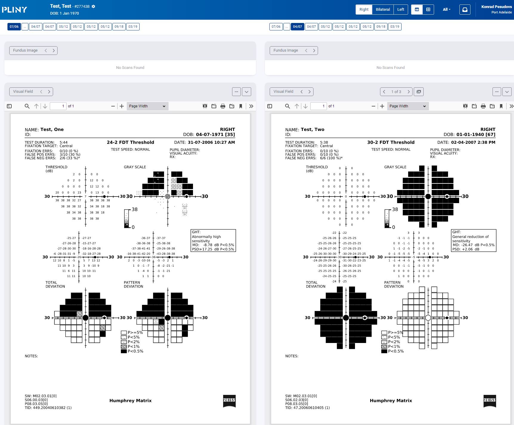 Tony - More than 15 years of visual field test results from the Tony ...