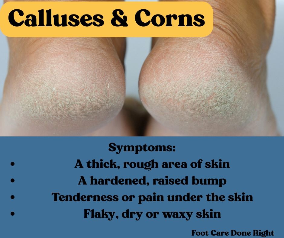 Foot - Corns and Calluses • Corns are smaller and deeper than calluses ...