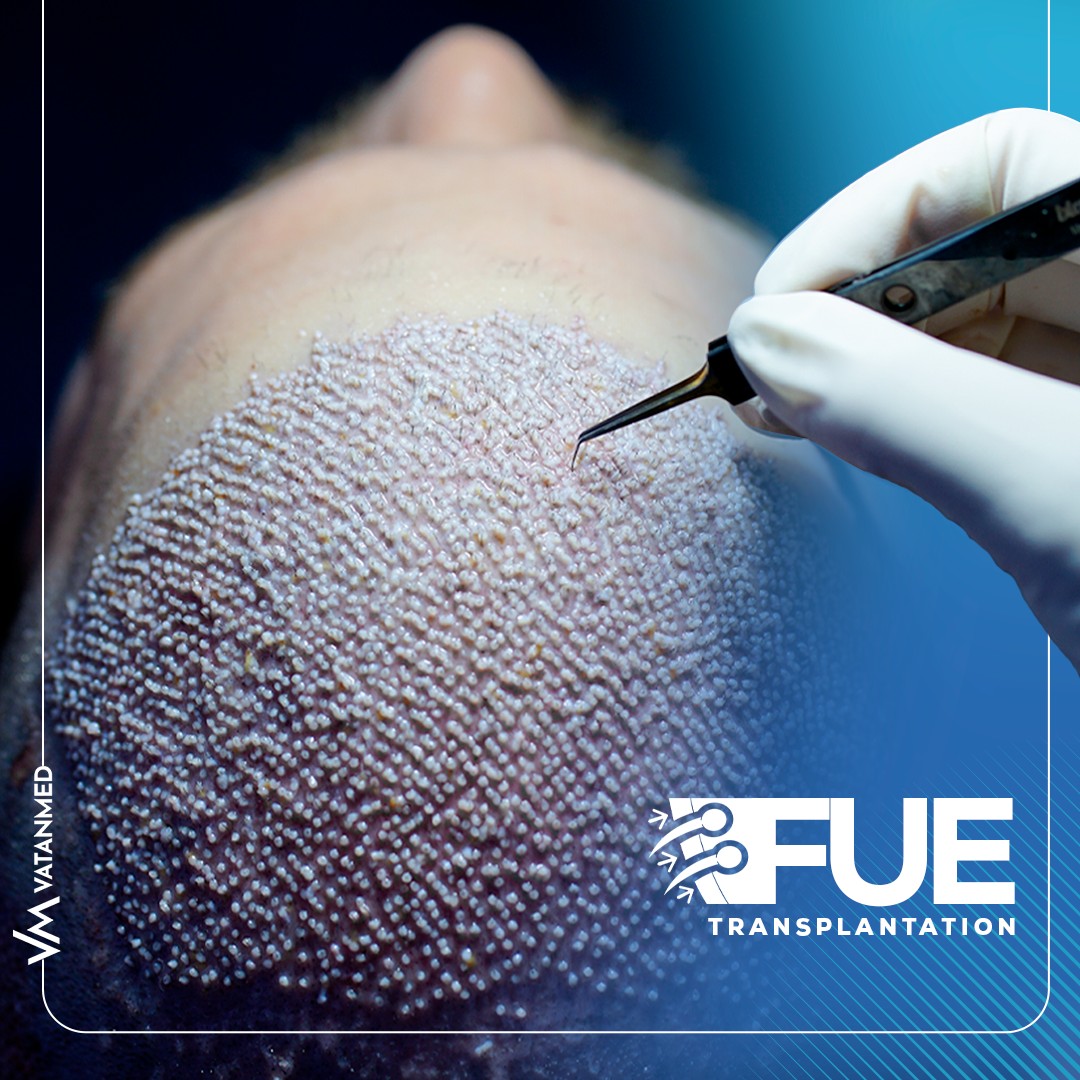 Vatanmed Clinic Istanbul - MEET THE FUE TECHNIQUE IN HAIR TRANSPLANT ...