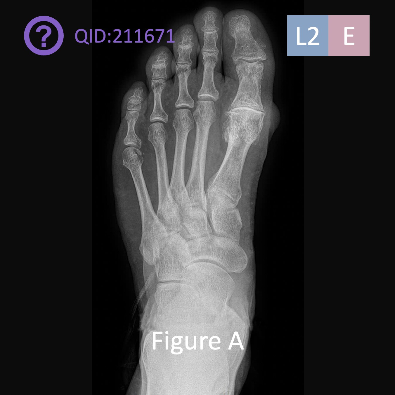 Xray Of Normal Foot