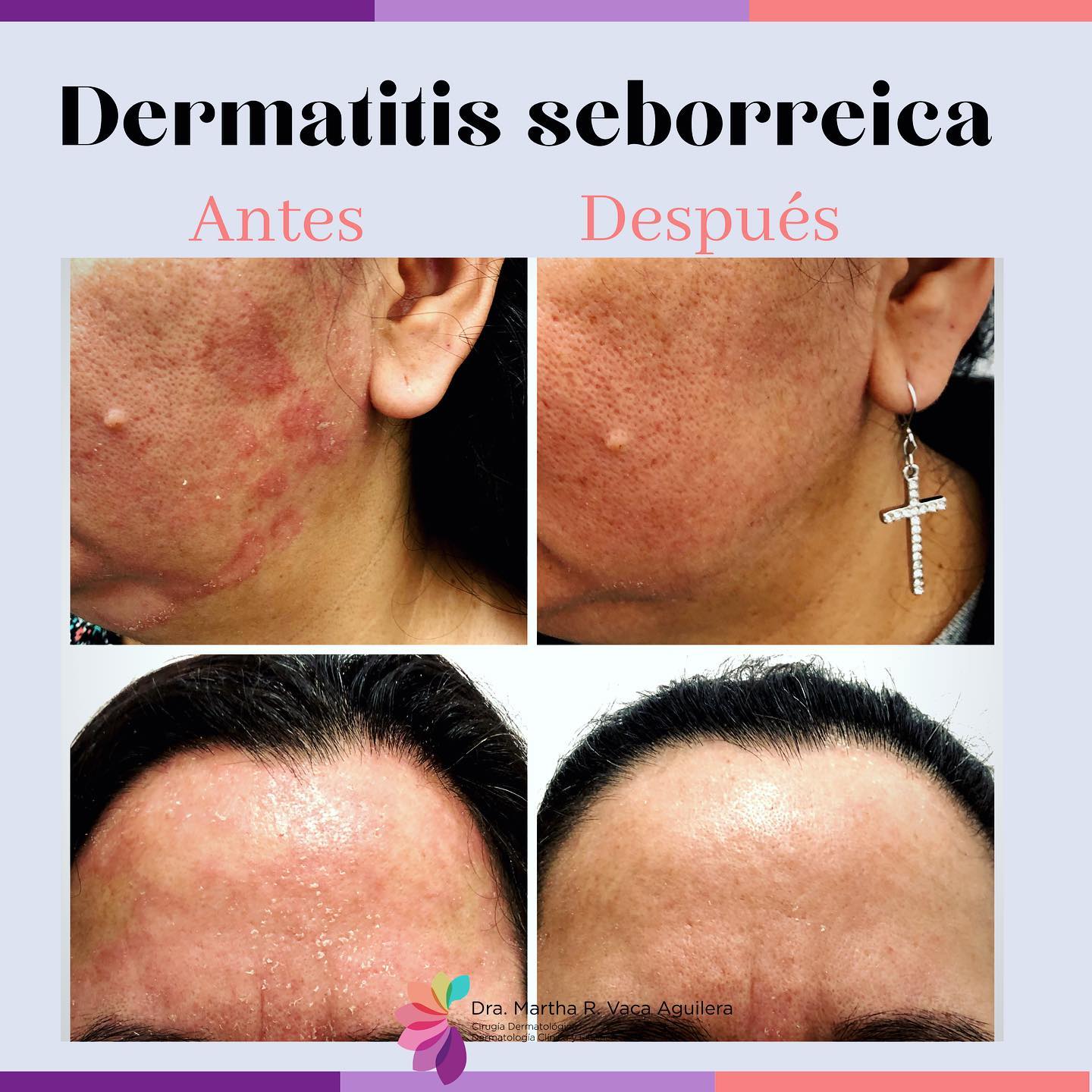 MV Skin Center - DERMATITIS SEBORREICA o seborrea, o cara roja con ...