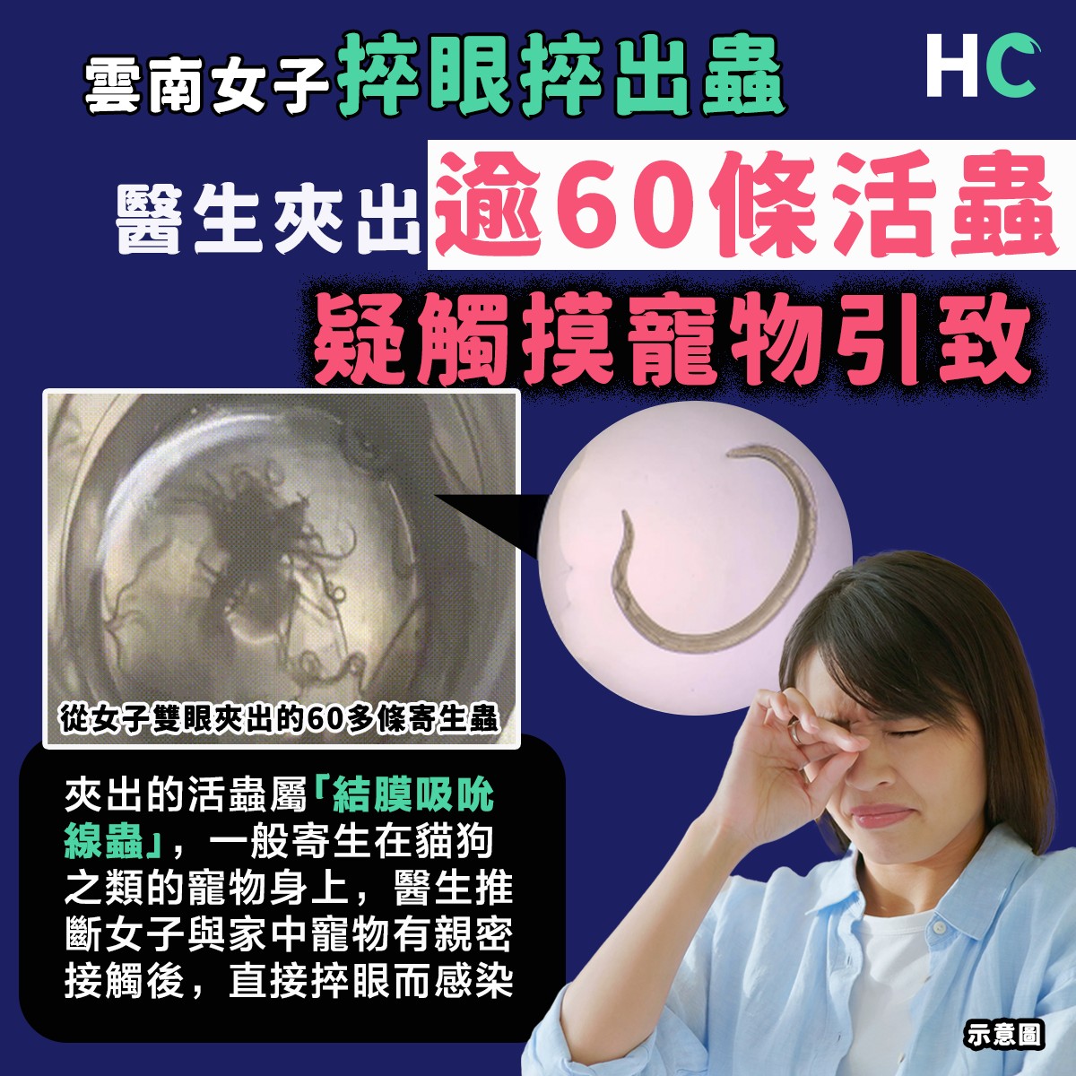 結膜吸吮線蟲】雲南女子捽眼捽出蟲 醫生夾出逾60條活蟲... - Health Concept 健康概念 | Facebook