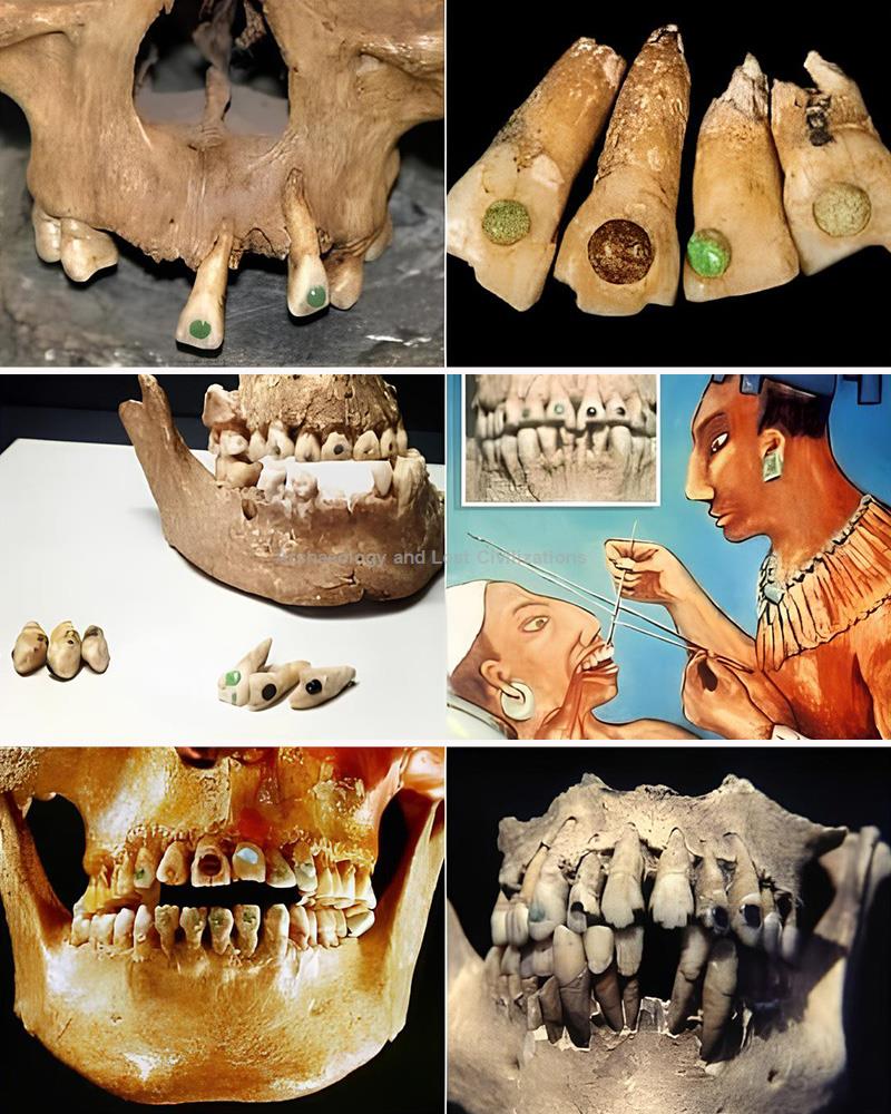 A small, brilliant piece of jade embedded directly into a human molar ...