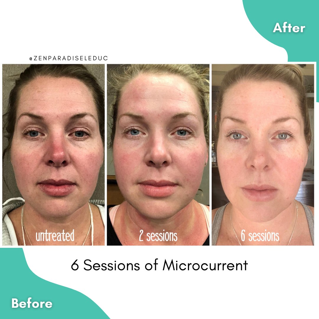 Microcurrents COMBINES... - Zen Paradise Massage & Wellness