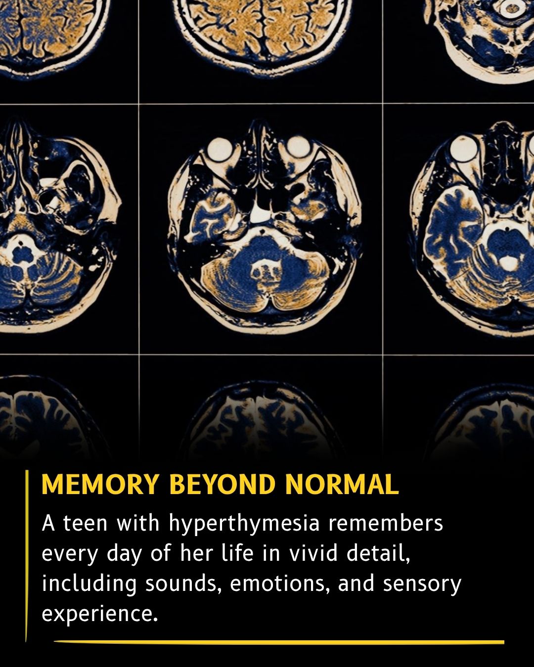 Science - A teenager known as TL has hyperthymesia, one of the rarest ...