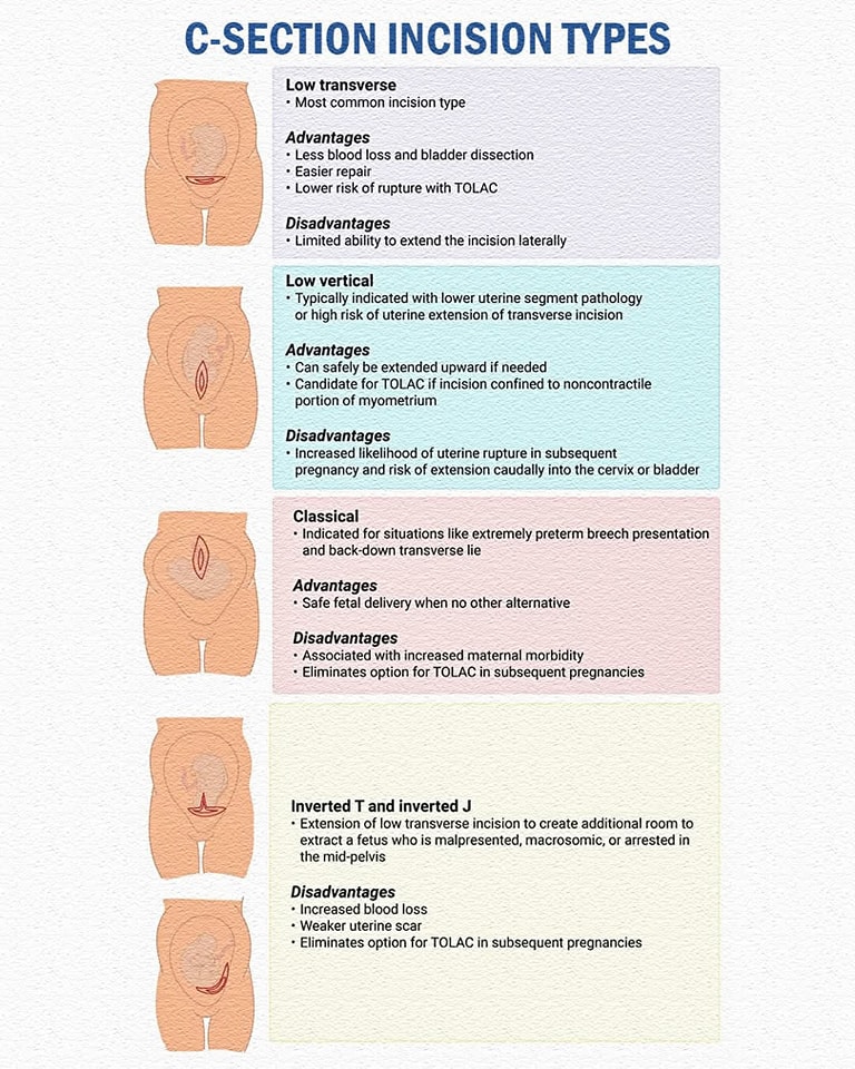 Types of C-Section Incisions ️👶 A... - Dr Ismaaciil Tool | Facebook