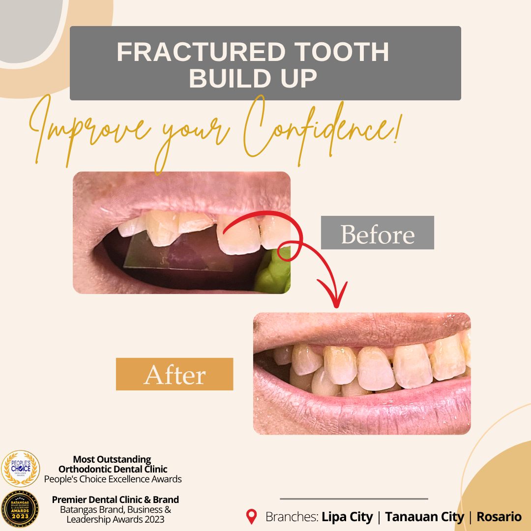 Recently, a patient... - Pangilinan Dental Clinic Tanauan | Facebook