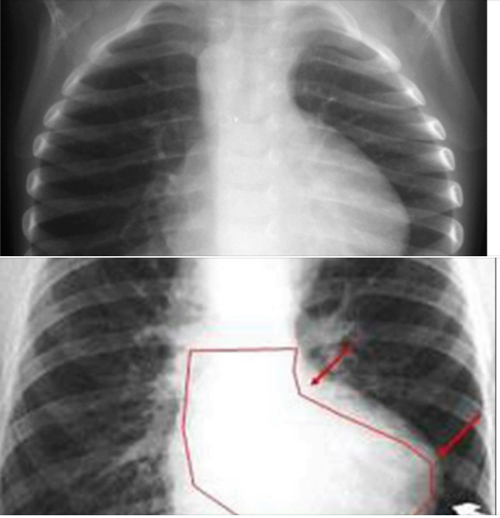 Pedia4PG - #drsidharthsethi #CVS Chest X Ray in TOF: -The classic chest ...