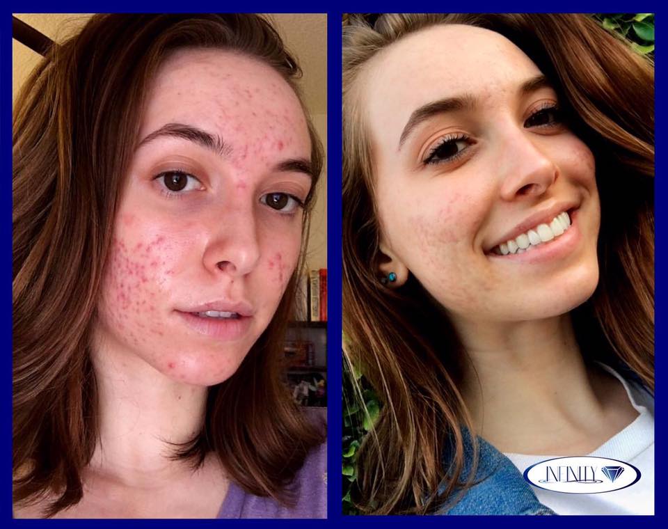 🔷Conoce crema natural... - Infinity / Tratamientos para acné | Facebook