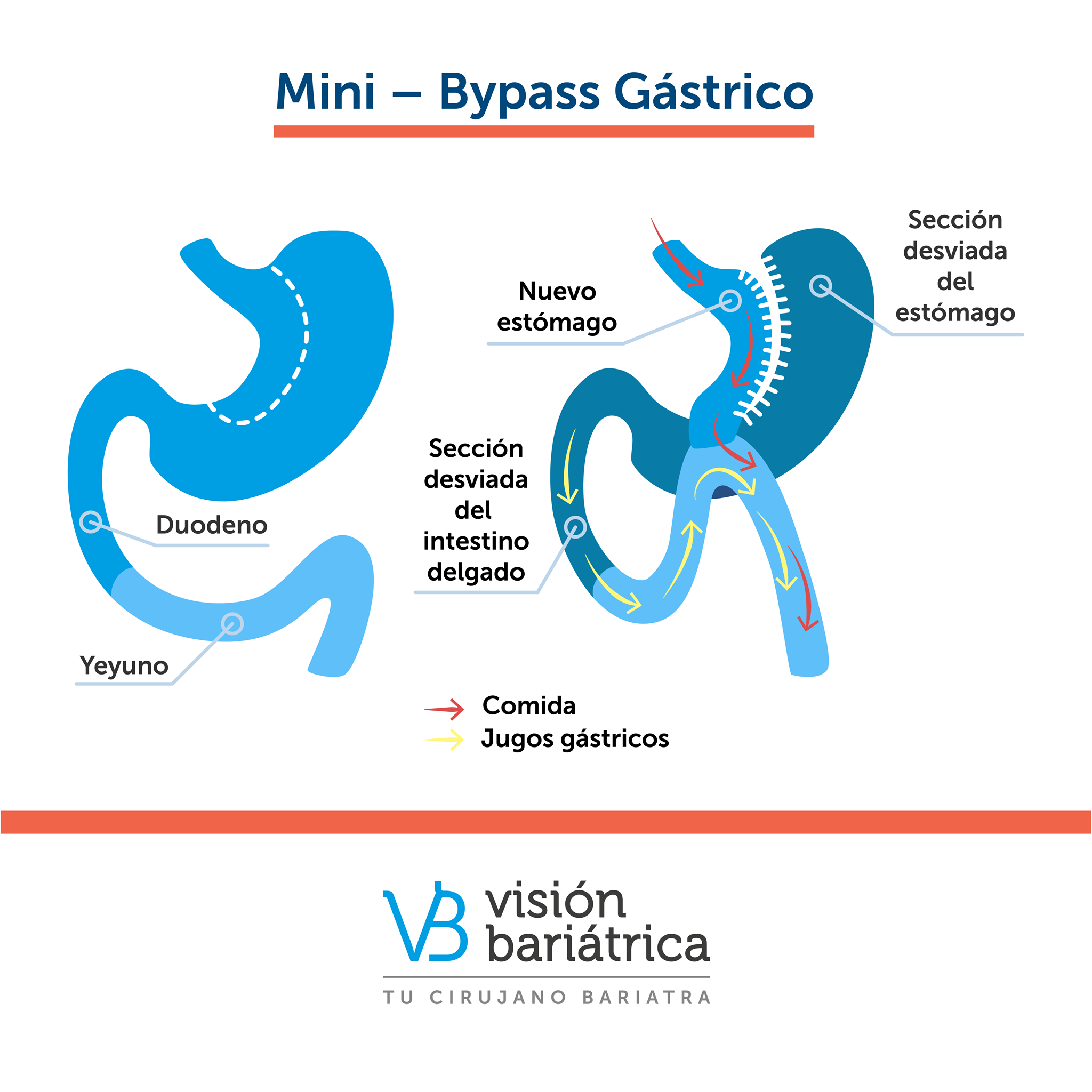 El Mini Bypass Gástrico, o Bypass... - Visión Bariátrica | Facebook