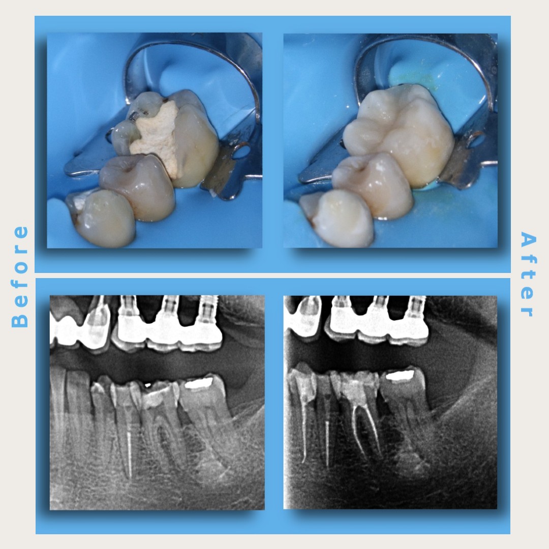 Dr. - 💎 Tratamente endodontice cu obturatii coronare fizionomice