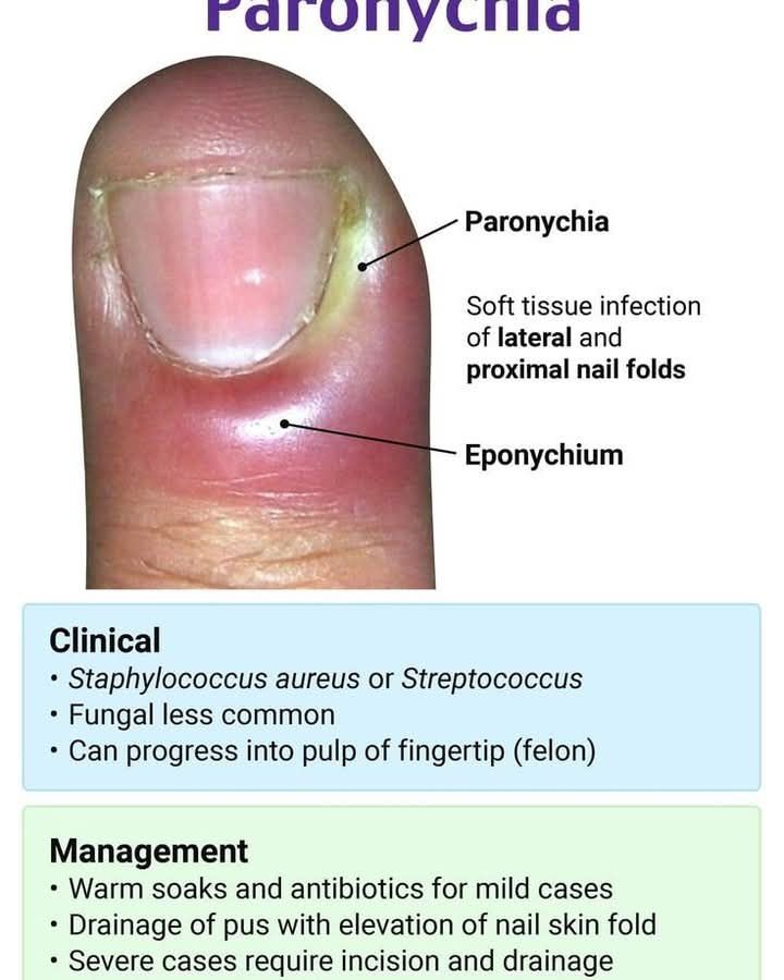 whitlow melanotic Search Results: Thumb, Rash or multiple lesions, 50-59 year old Female Pediatric and Adolescent Nail Disorders