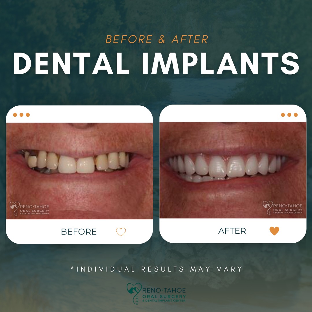 Reno Tahoe Oral Surgery & Implant Center | Reno NV