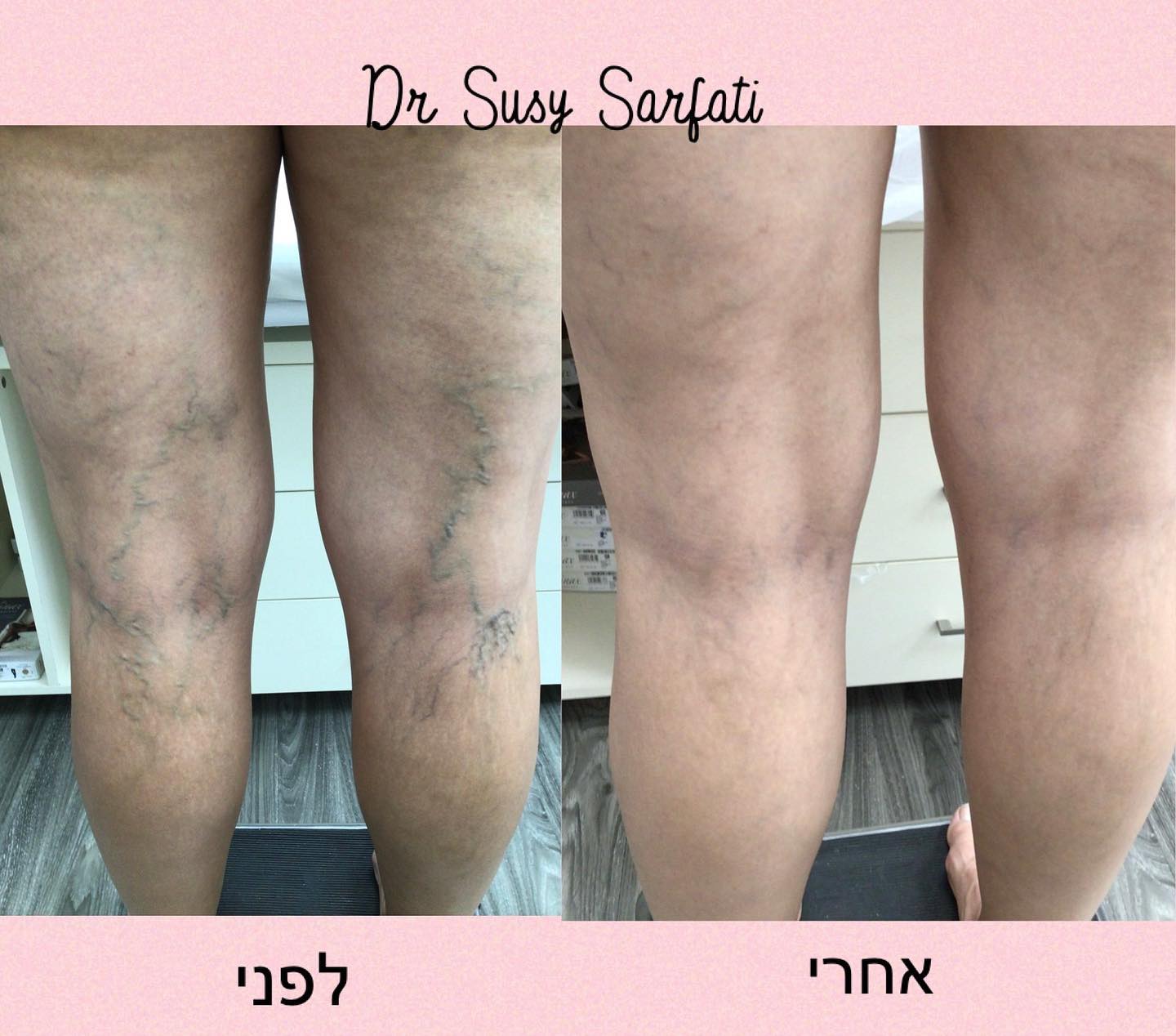 העלמת נימים , ורידים :... - Israel Vein Clinic ד׳ר סוזי סרפתי