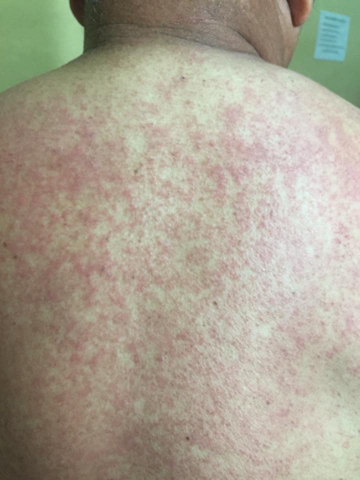 นายแพทย์สมาธิ - ผื่นแพ้ยาแบบ คล้ายหัด(Maculopapular... | Facebook