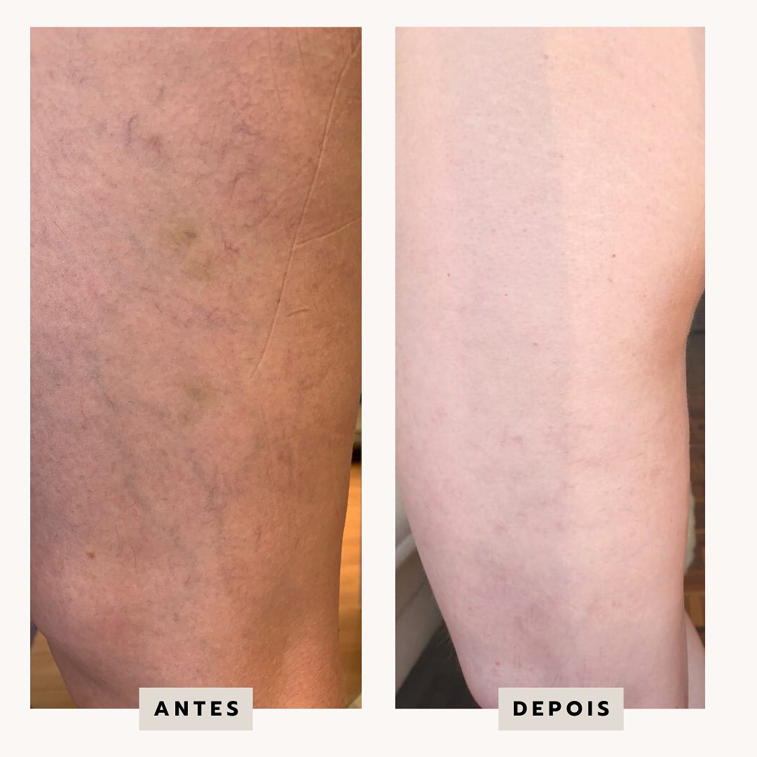 Veias Reticulares