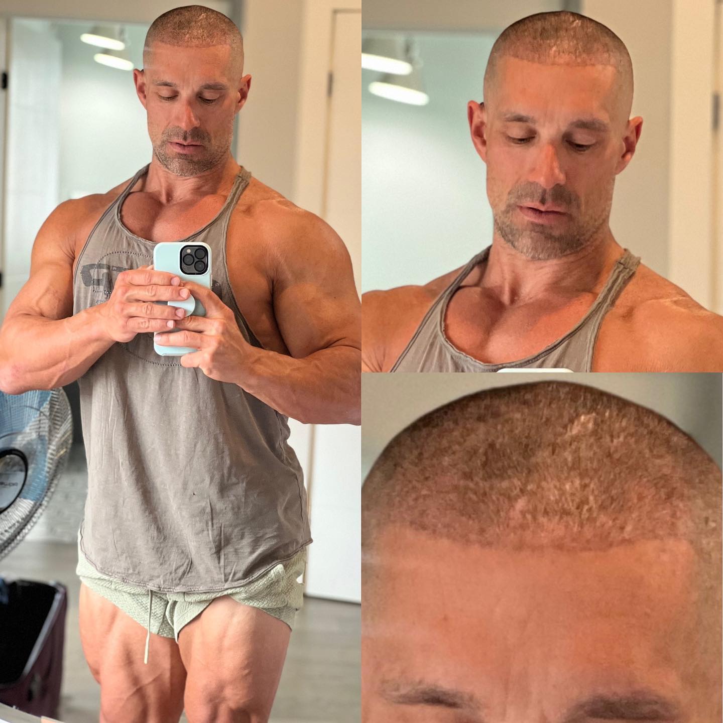bpc 157 greg doucette Doucette's hair transplant update after 3 months Size:30 ml x 2 Cyanocobalamin Medicare Coverage and IM Injection