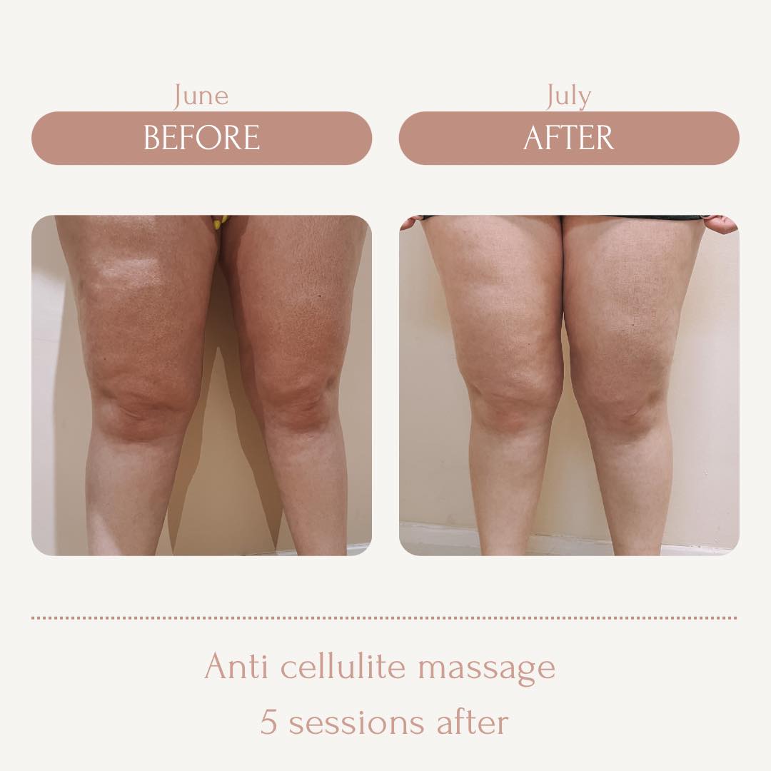 Anti Cellulite Massage In Der Nhe