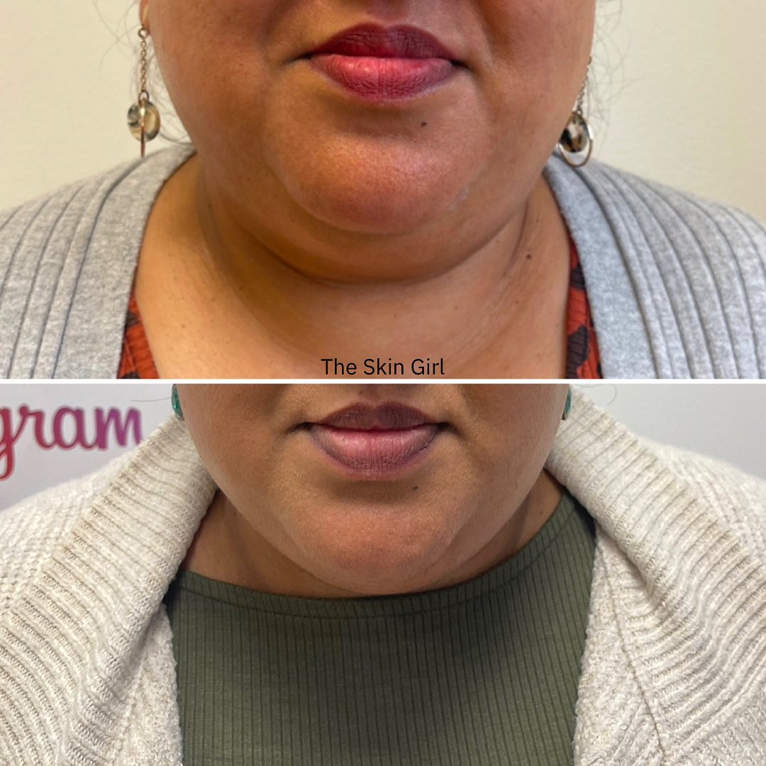lemon bottle fat dissolver before and after dissolving 3 days on under chin #lemonbottlefatdissolving #lemonbottle #fatdissolvinginjections #fatdisolvingdublin #fatdissolvinglucan #premieraestheticsdublin Before & After  Lemon