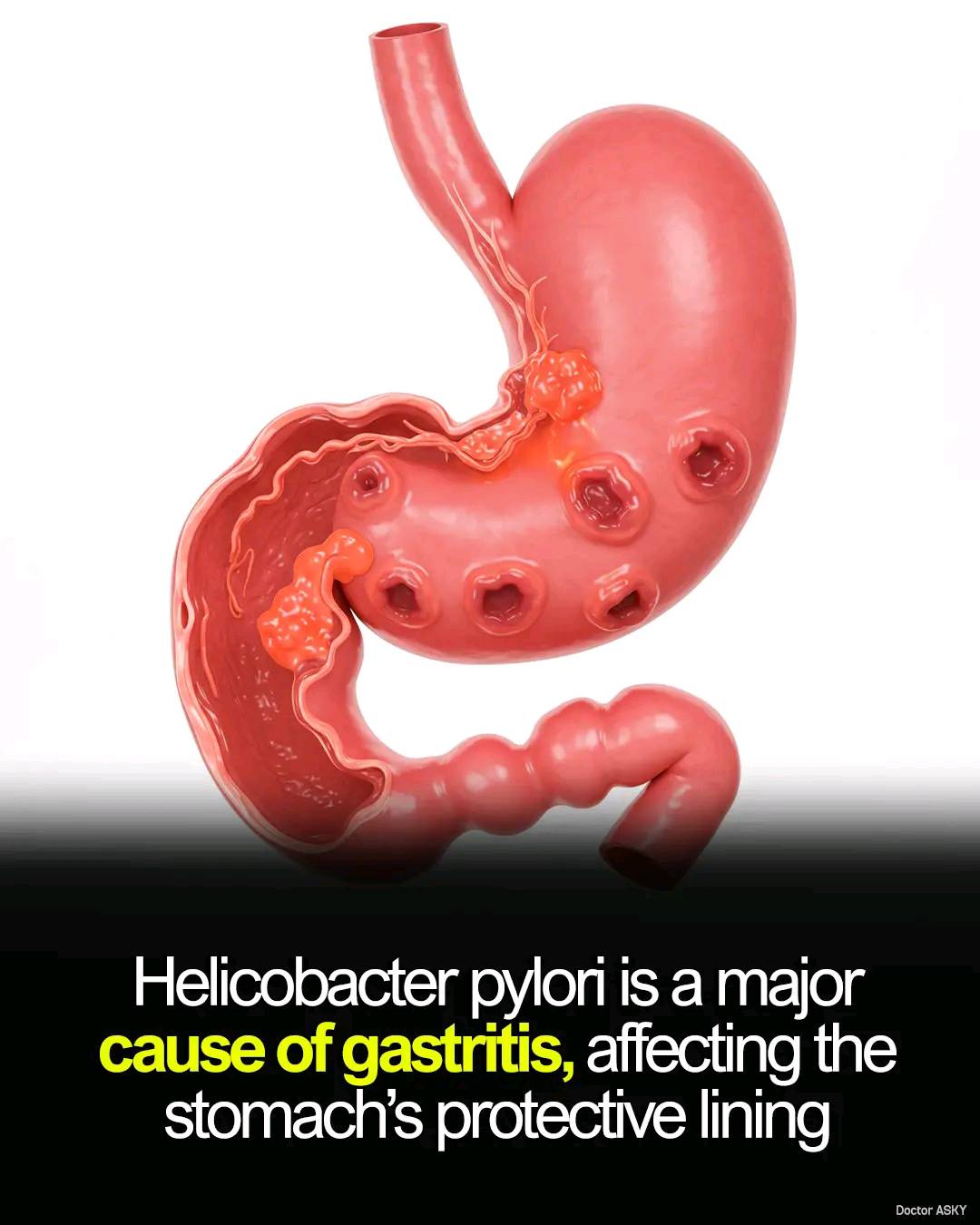 Gastritis is a condition where the lining of the stomach becomes inflamed.  This inflammation can happen for various reasons, such as infection with a  bacteria called Helicobacter pylori, drinking too much alcohol,