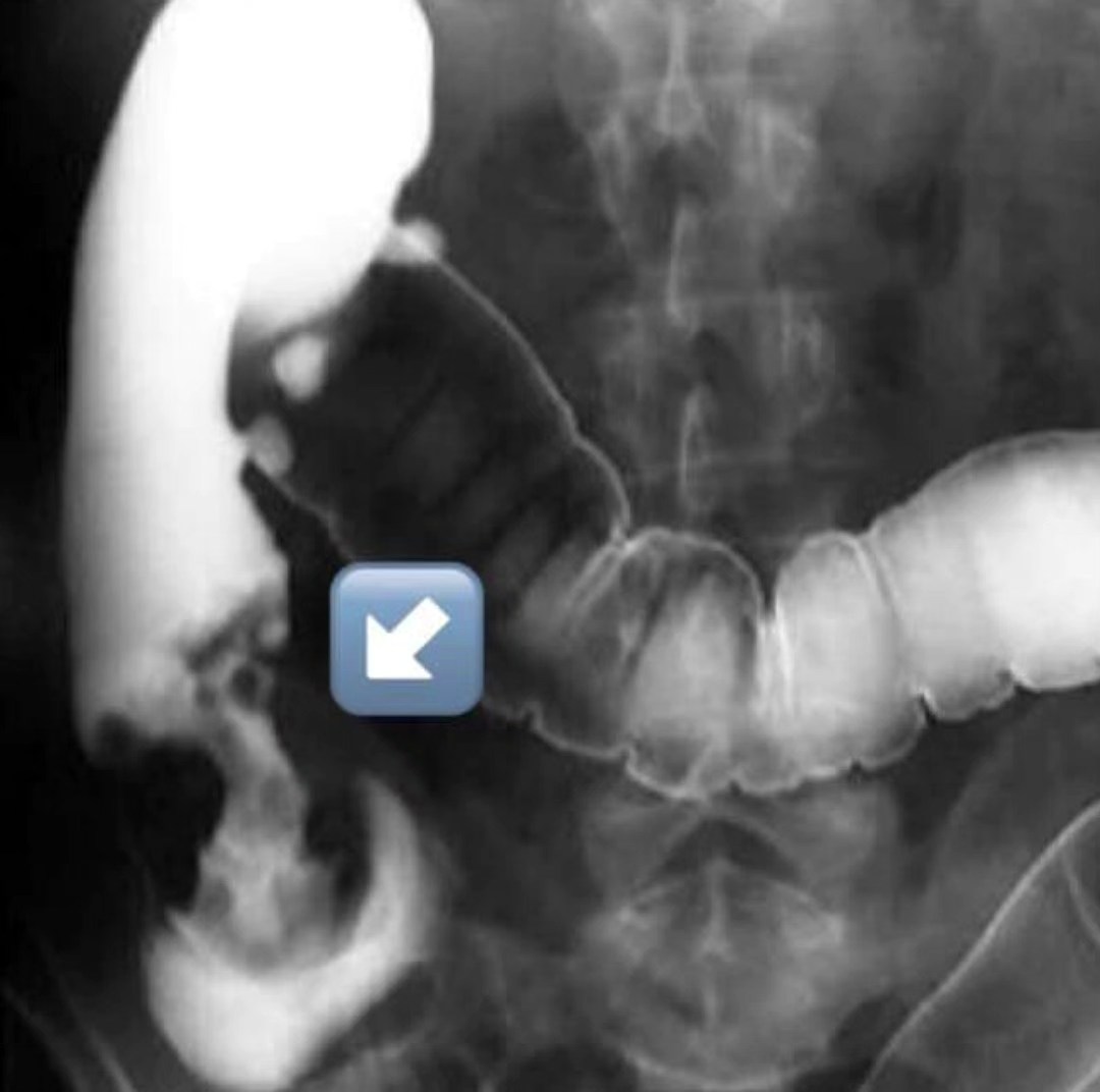 Rx pediatrica - Los tumores malignos del colon pueden... | Facebook