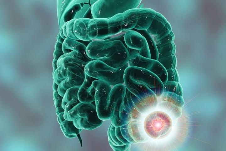 SRB IMUNOTERAPIJA- KARCINOM, TUMOR, RAK