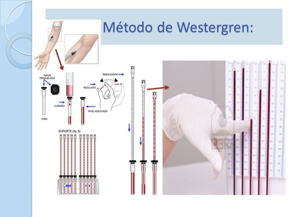 UPS LAB - VELOCIDAD DE SEDIMENTACIÓN GLOBULAR (VSG) La... | Facebook