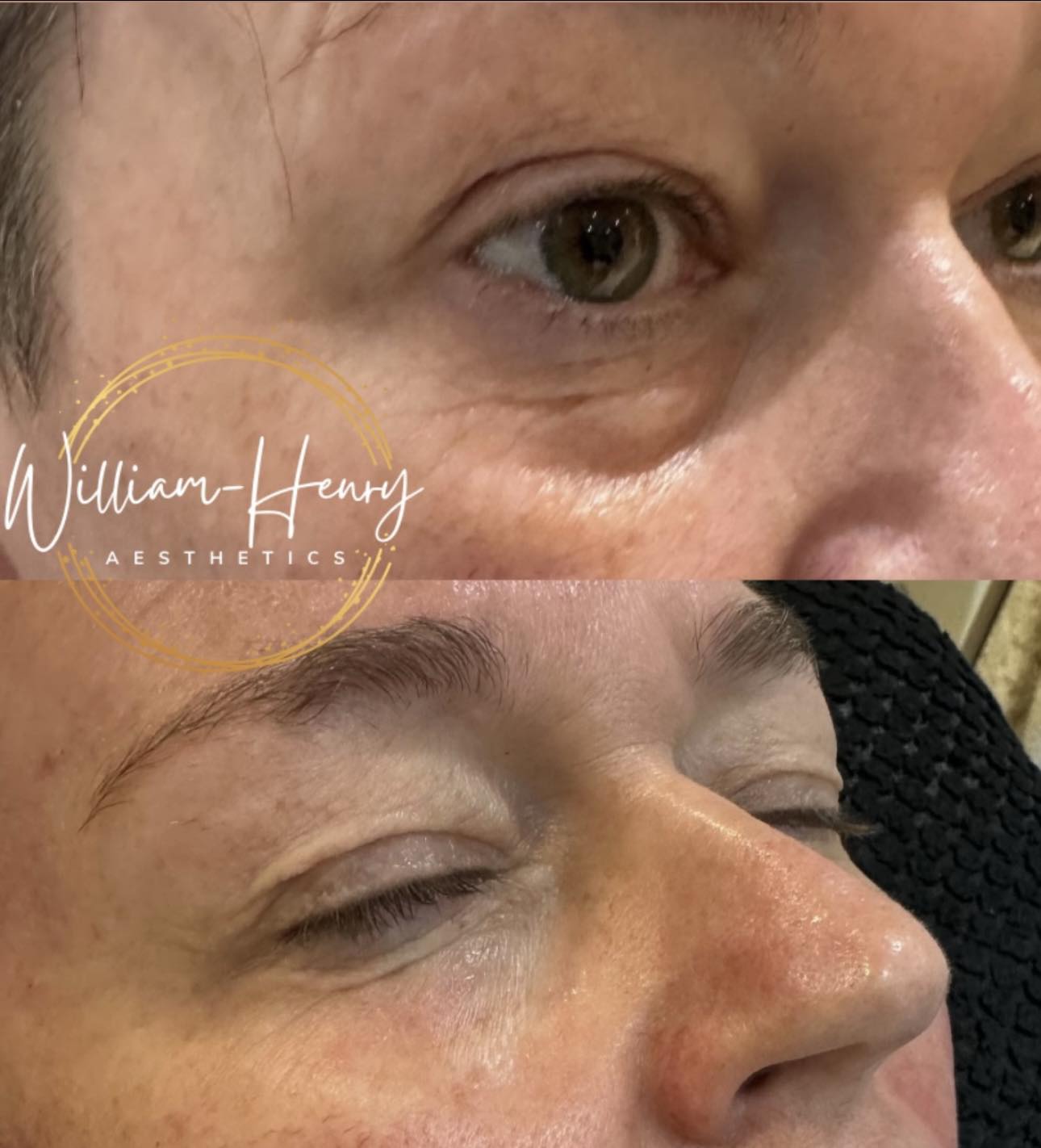 What causes dark circles under eyes from not absorbing nutrients properly?