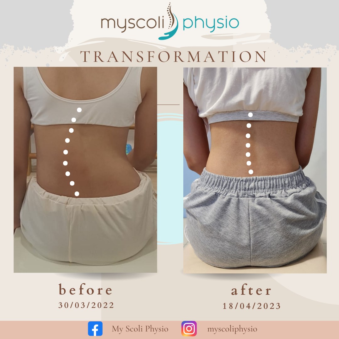 My Scoli Physio - 脊柱侧弯个案见证分享 ...